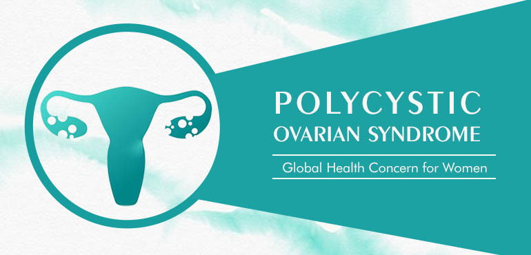 Polycystic Ovarian Syndrome| Global Health Concern for Women